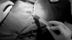 axillary vein access