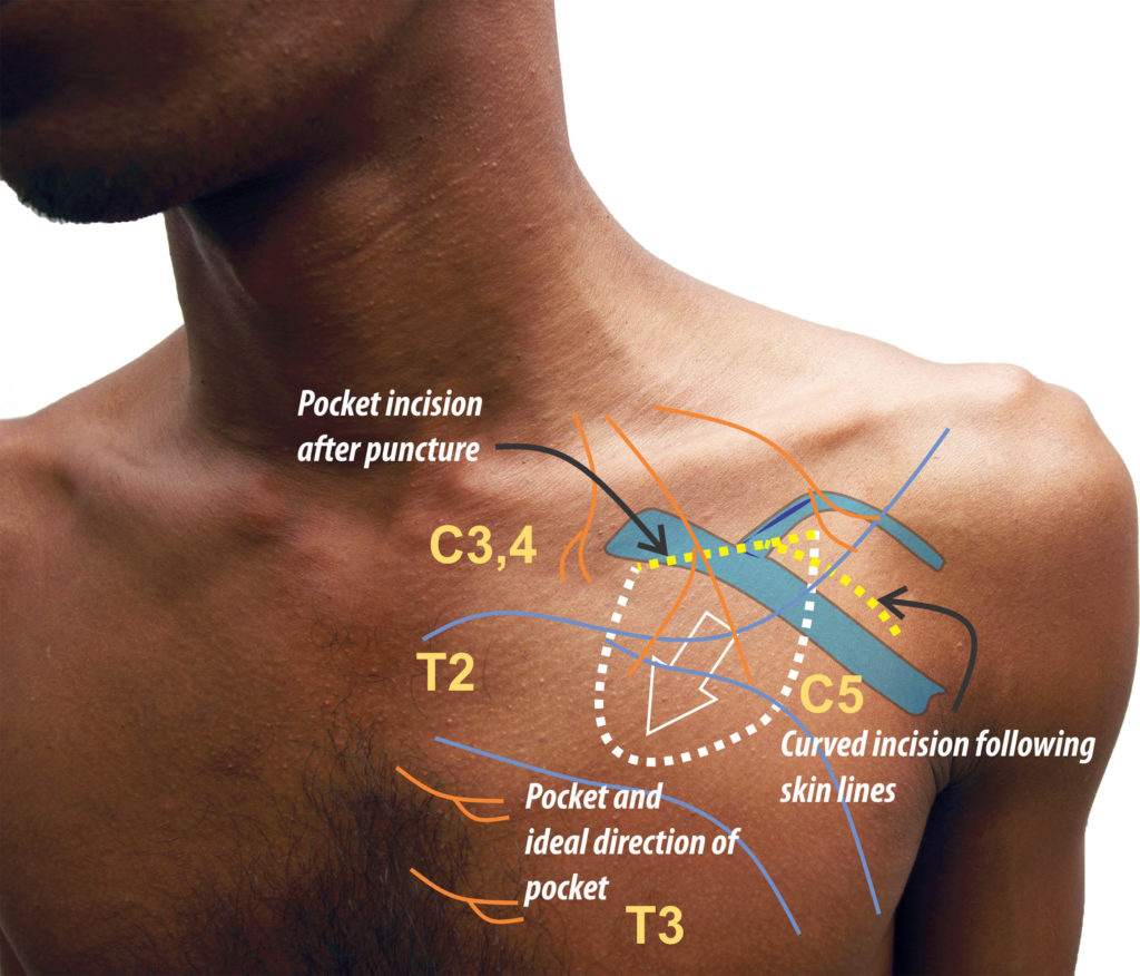 Chestwall nerves how to pace