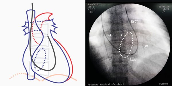 Septal Implantation of Right Ventricular Lead – How to Pace