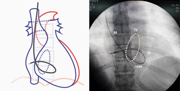 Septal Implantation of Right Ventricular Lead – How to Pace