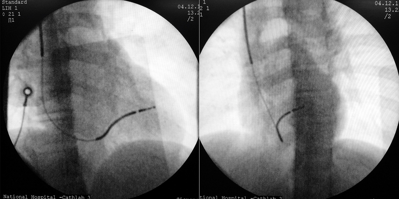 icd 10 code for rv lead malfunction