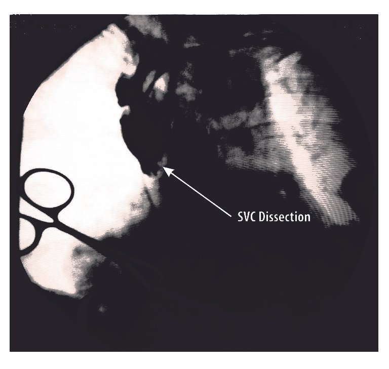 Svc Rupture svc-dissect – How to Pace